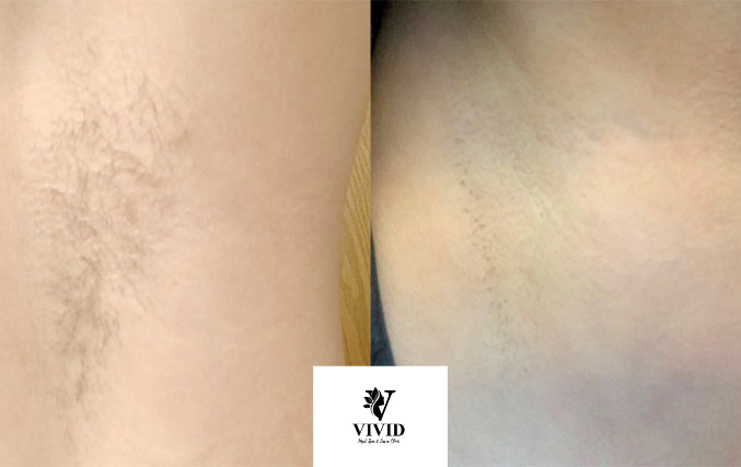 hair removal (4)