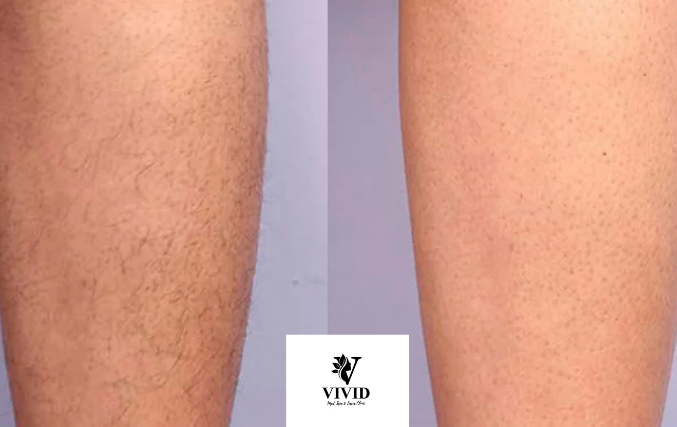 hair removal (5)