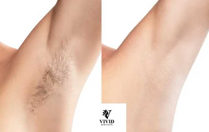 hair removal (6)